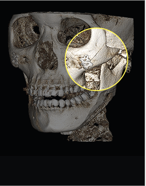 cheekbone reduction korea - Face Contouring