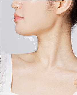 double chin lift korea - Double Chin Lift