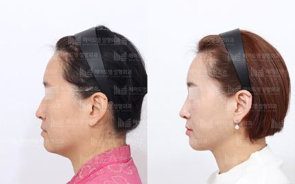 face contouring korea before after pictures - Face Contouring Before and After