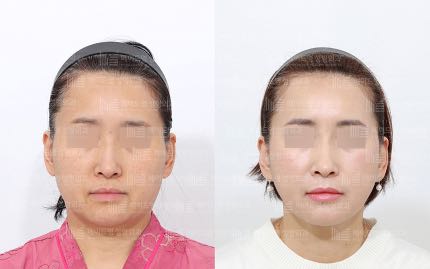 face contouring korea before after pictures - Face Contouring Before and After