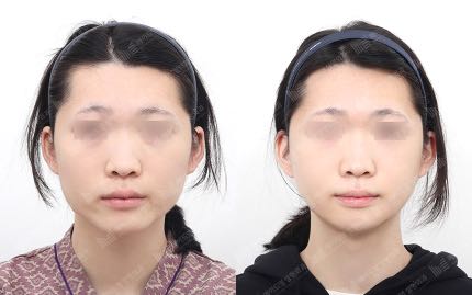 face contouring korea before after pictures - Face Contouring Before and After