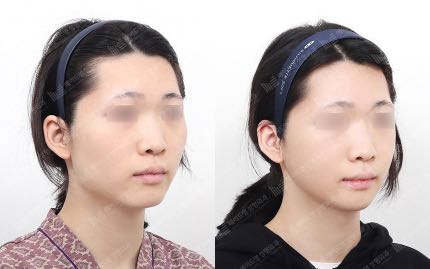 face contouring korea before after pictures - Face Contouring Before and After