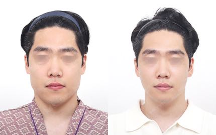 face contouring korea before after pictures - Face Contouring Before and After