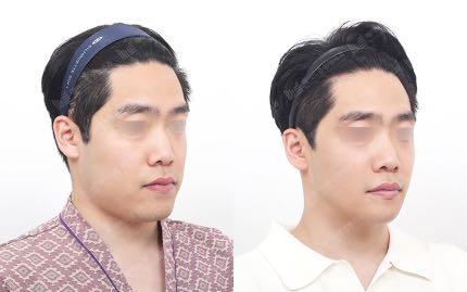 face contouring korea before after pictures - Face Contouring Before and After