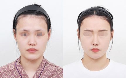 face contouring korea before after pictures - Face Contouring Before and After