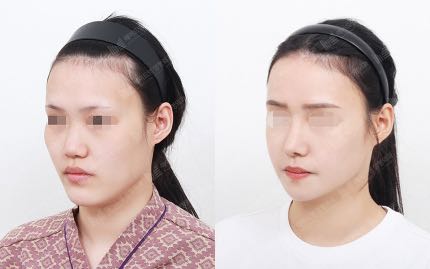 face contouring korea before after pictures - Face Contouring Before and After