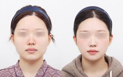 face contouring korea before after pictures - Face Contouring Before and After