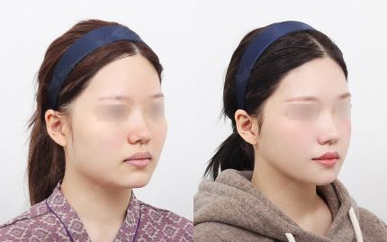 face contouring korea before after pictures - Face Contouring Before and After