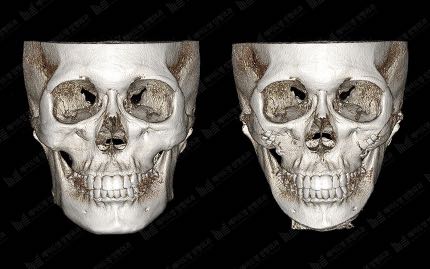 face contouring korea before after pictures - Face Contouring Before and After