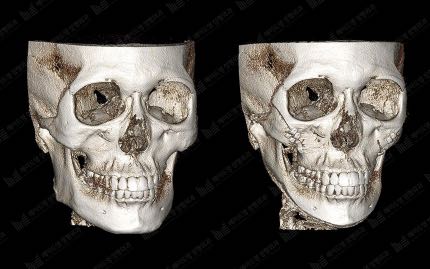 face contouring korea before after pictures - Face Contouring Before and After