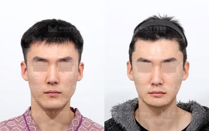 face contouring korea before after pictures - Face Contouring Before and After