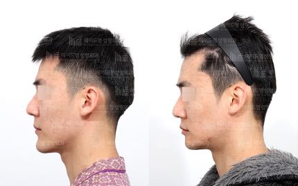 face contouring korea before after pictures - Face Contouring Before and After