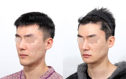 face contouring korea before after pictures - Face Contouring Before and After