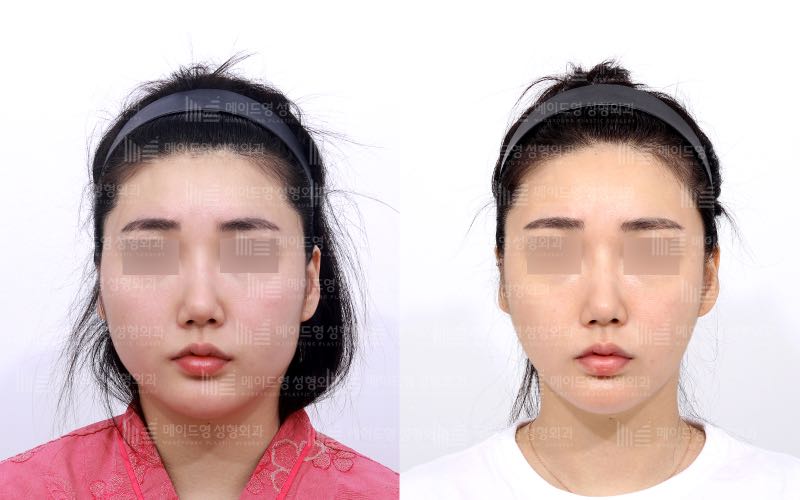 face contouring korea before after pictures - Face Contouring Before and After