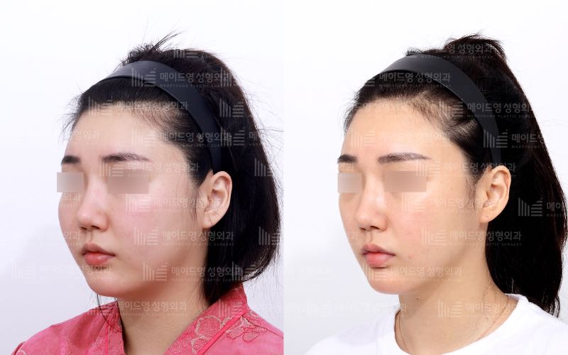 face contouring korea before after pictures - Face Contouring Before and After