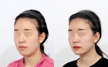 face contouring korea before after pictures - Face Contouring Before and After