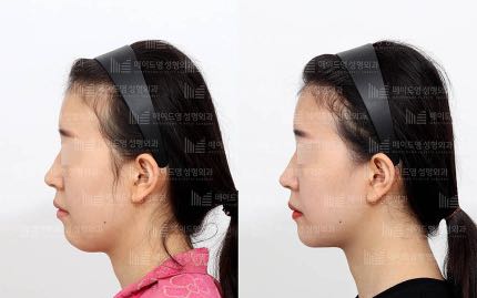 face contouring korea before after pictures - Face Contouring Before and After