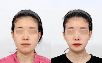 face contouring korea before after pictures - Face Contouring Before and After