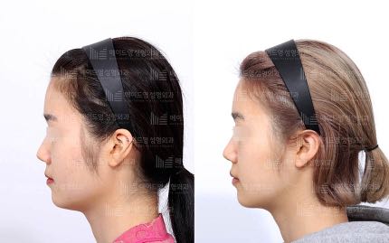 face contouring korea before after pictures - Face Contouring Before and After