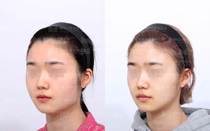 face contouring korea before after pictures - Face Contouring Before and After