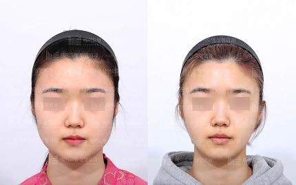face contouring korea before after pictures - Face Contouring Before and After