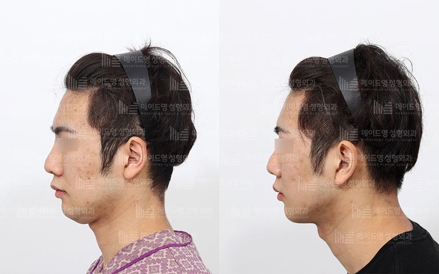 face lifting korea before after pictures - Lifting Before and After
