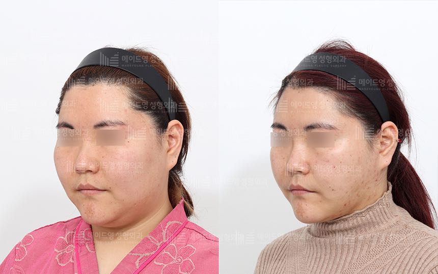 face lifting korea before after pictures - Lifting Before and After