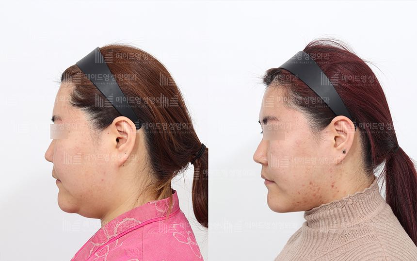 face lifting korea before after pictures - Lifting Before and After