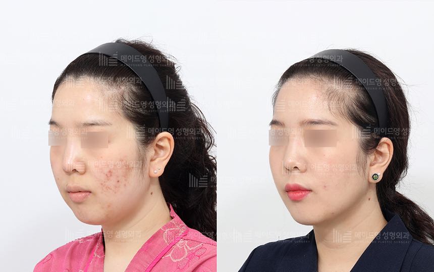 face lifting korea before after pictures - Lifting Before and After