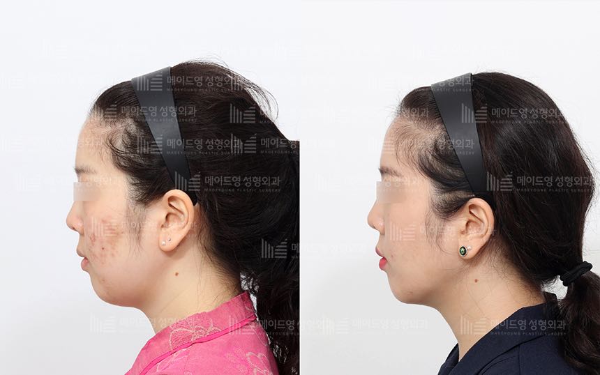 face lifting korea before after pictures - Lifting Before and After