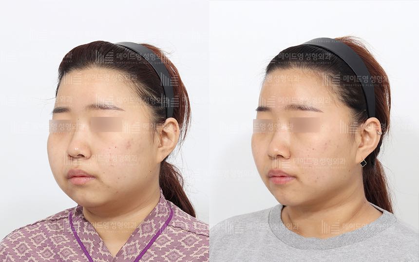 face lifting korea before after pictures - Lifting Before and After