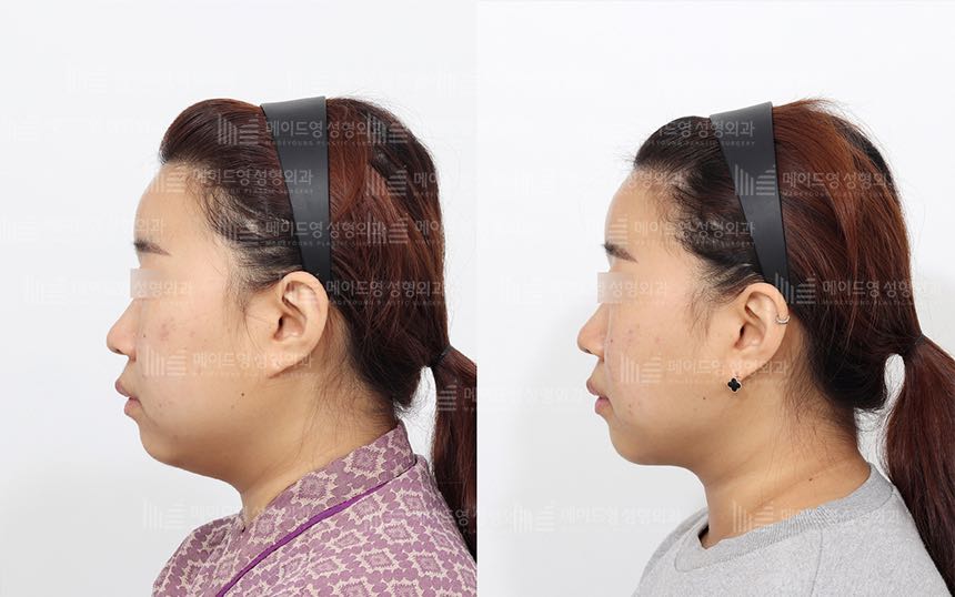 face lifting korea before after pictures - Lifting Before and After