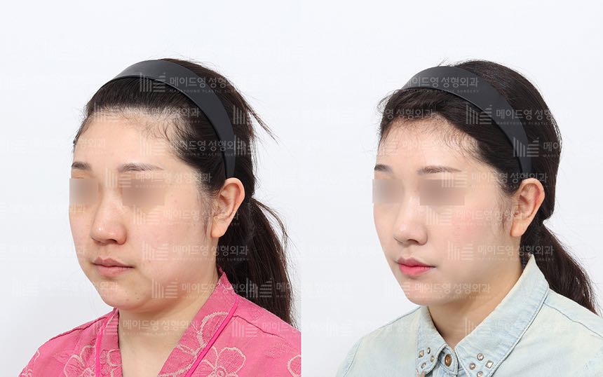 face lifting korea before after pictures - Lifting Before and After