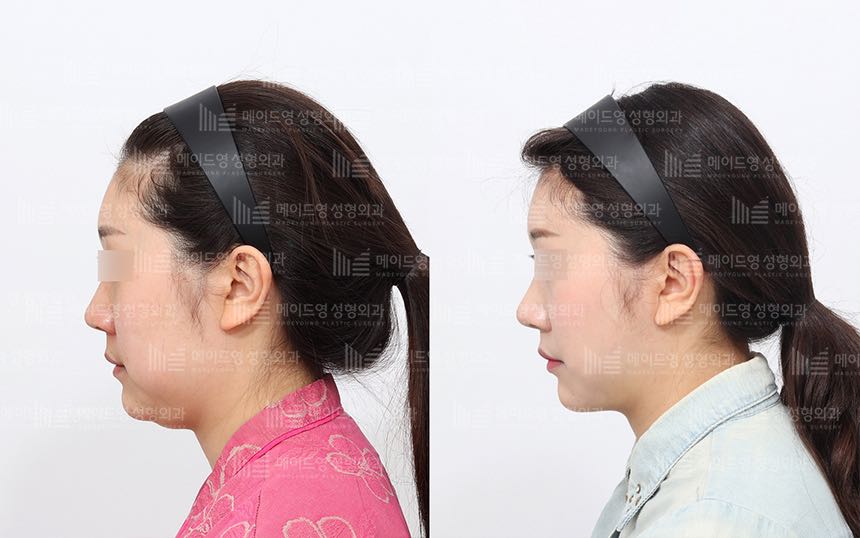 face lifting korea before after pictures - Lifting Before and After