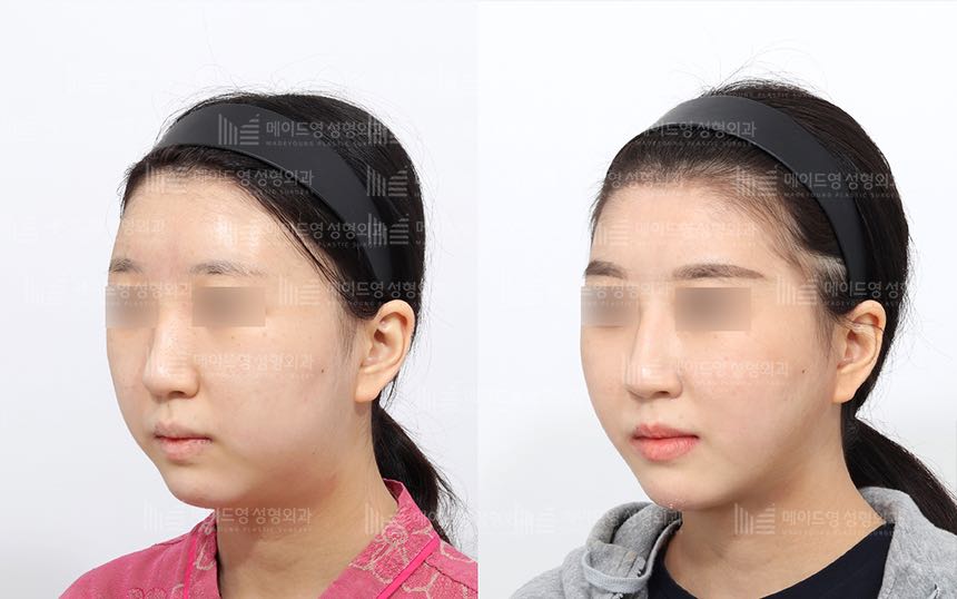 face lifting korea before after pictures - Lifting Before and After