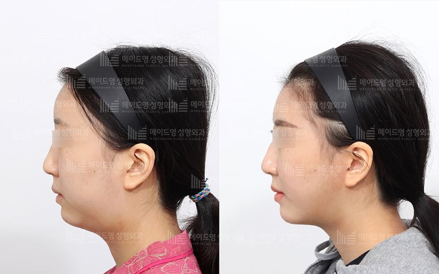 face lifting korea before after pictures - Lifting Before and After