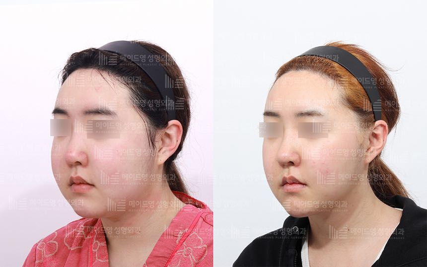 face lifting korea before after pictures - Lifting Before and After