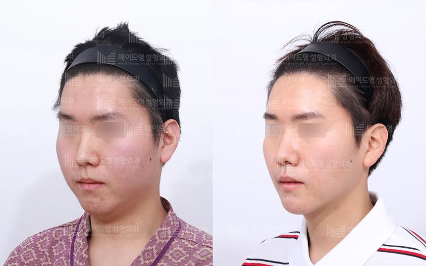 face lifting korea before after pictures - Lifting Before and After