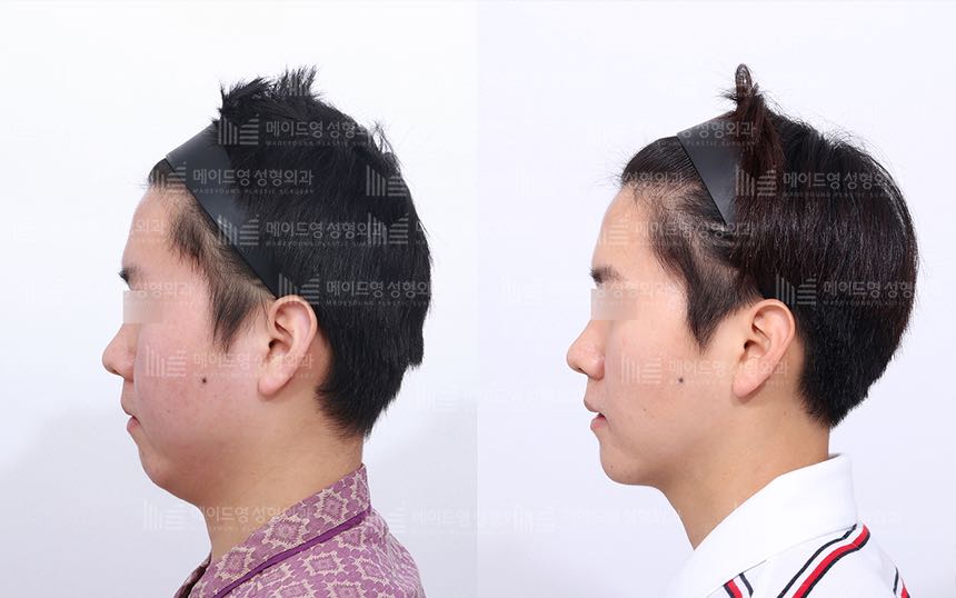 face lifting korea before after pictures - Lifting Before and After