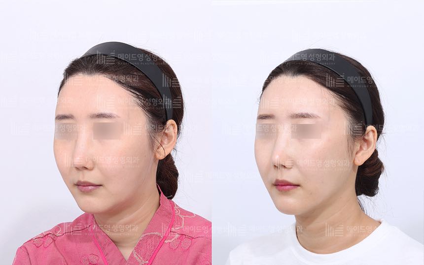 face lifting korea before after pictures - Lifting Before and After