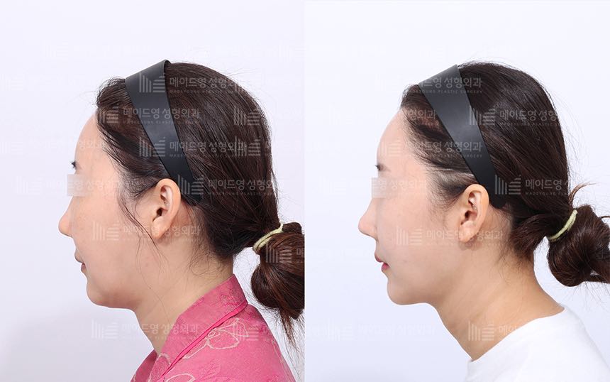 face lifting korea before after pictures - Lifting Before and After