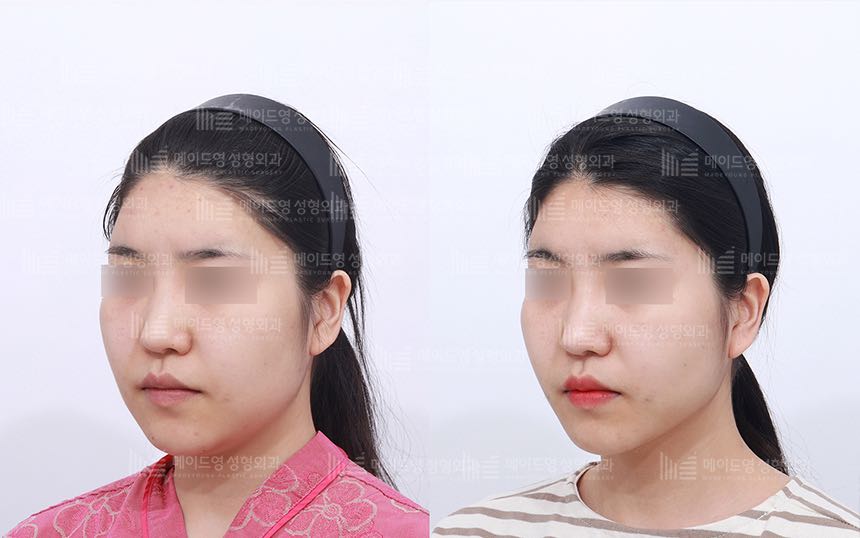 face lifting korea before after pictures - Lifting Before and After