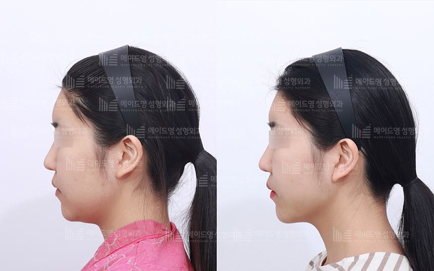 face lifting korea before after pictures - Lifting Before and After