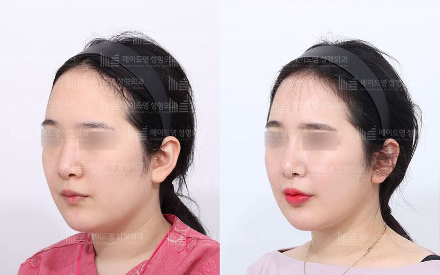 face lifting korea before after pictures - Lifting Before and After