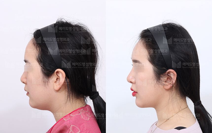 face lifting korea before after pictures - Lifting Before and After