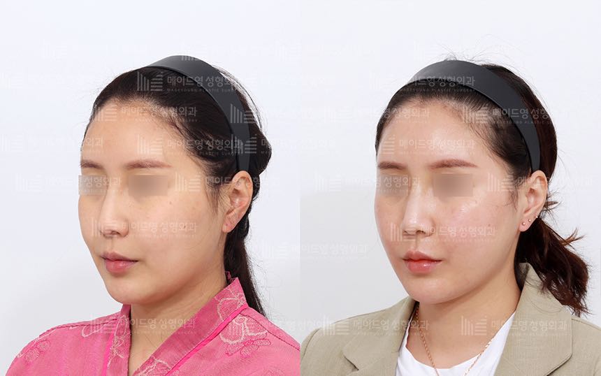 face lifting korea before after pictures - Lifting Before and After