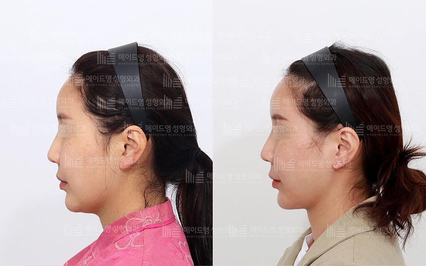 face lifting korea before after pictures - Lifting Before and After