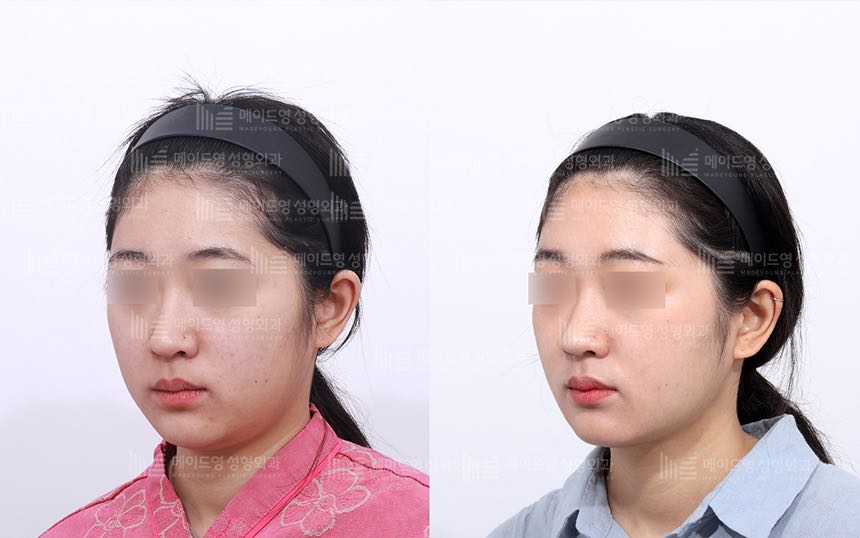 face lifting korea before after pictures - Lifting Before and After