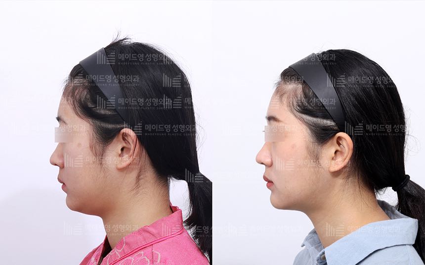 face lifting korea before after pictures - Lifting Before and After