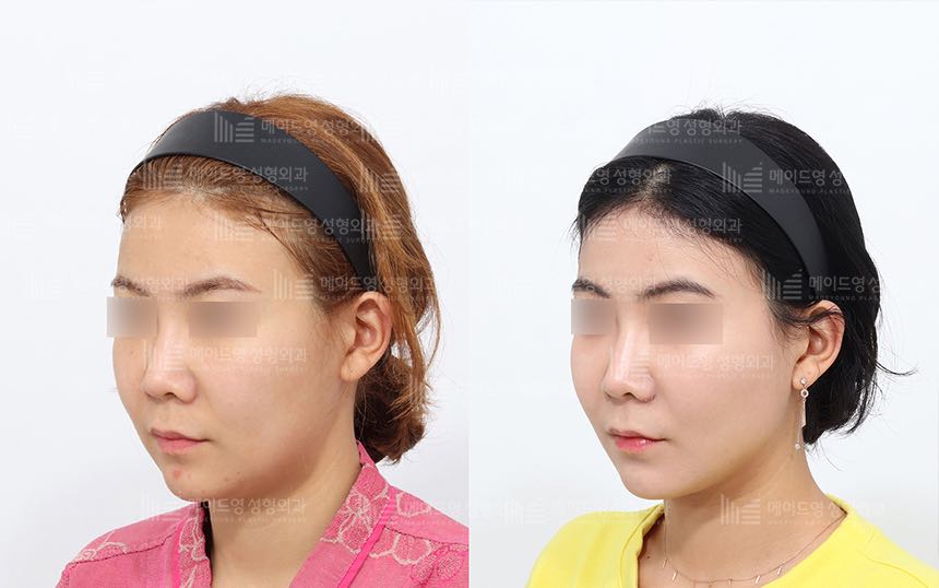 face lifting korea before after pictures - Lifting Before and After